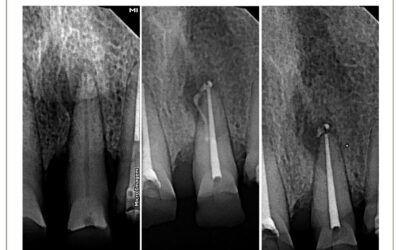 Periodontite apical assintomática. Relato de caso.