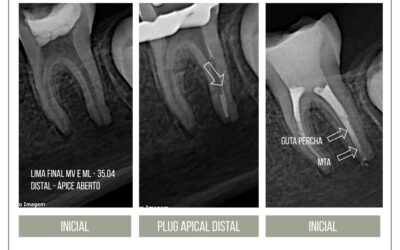 Plug apical de MTA em dente com rizogênese incompleta.