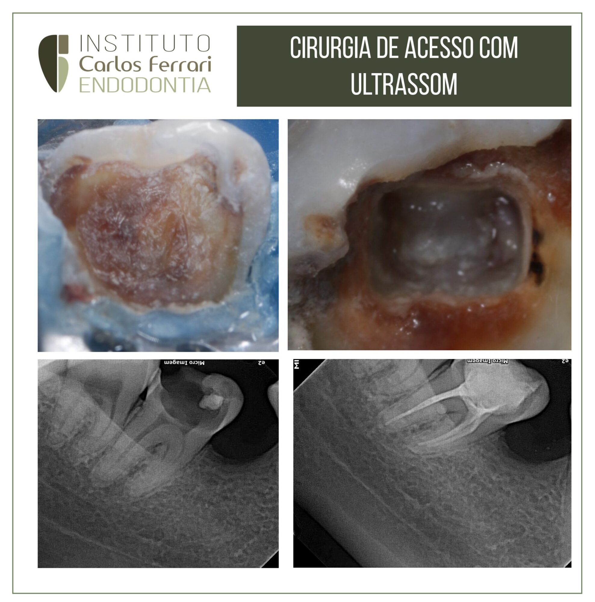 Ponta de ultrassom na endodontia para remoção de dentina terciária.