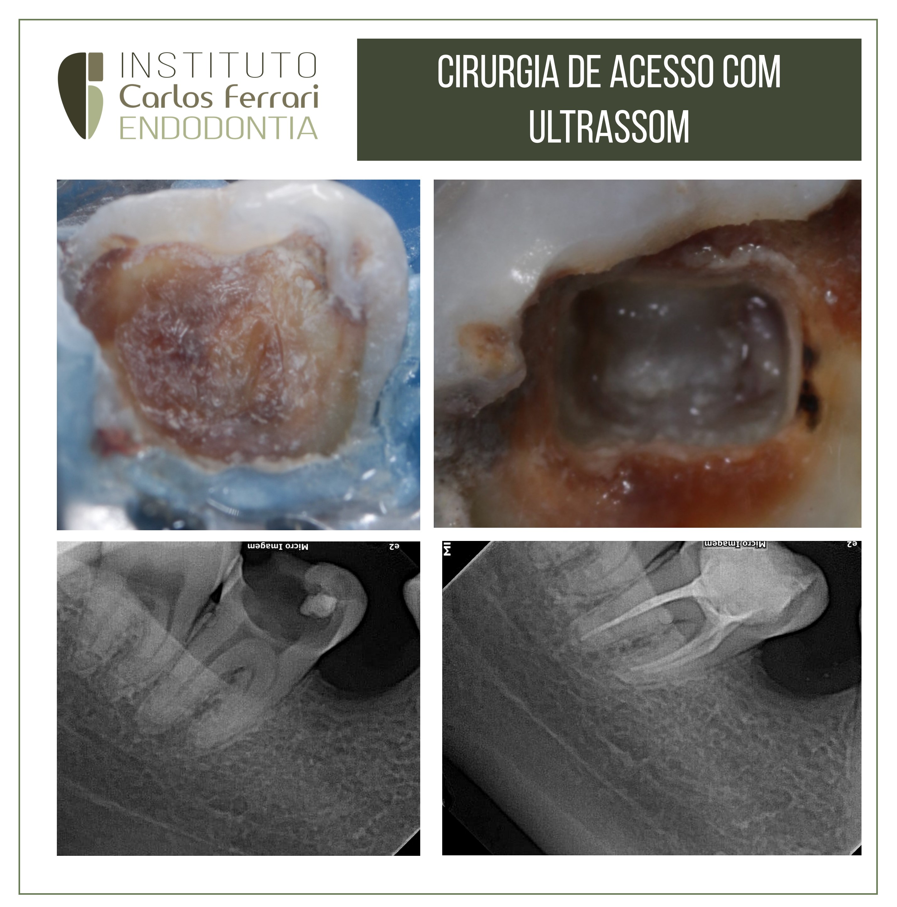 Ponta de ultrassom na endodontia para remoção de dentina terciária.