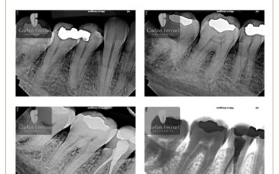 Pré-molar inferior. Tratamento de dente 45 com dois canais.