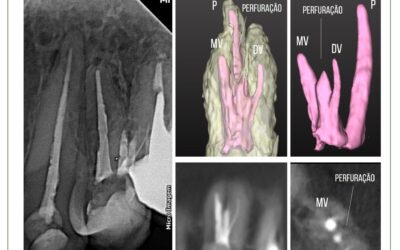 Pré-molar superior com três canais. Tratamento endodôntico.