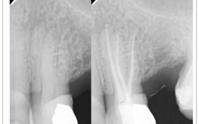 Pré-molar superior com três raízes e três canais.
