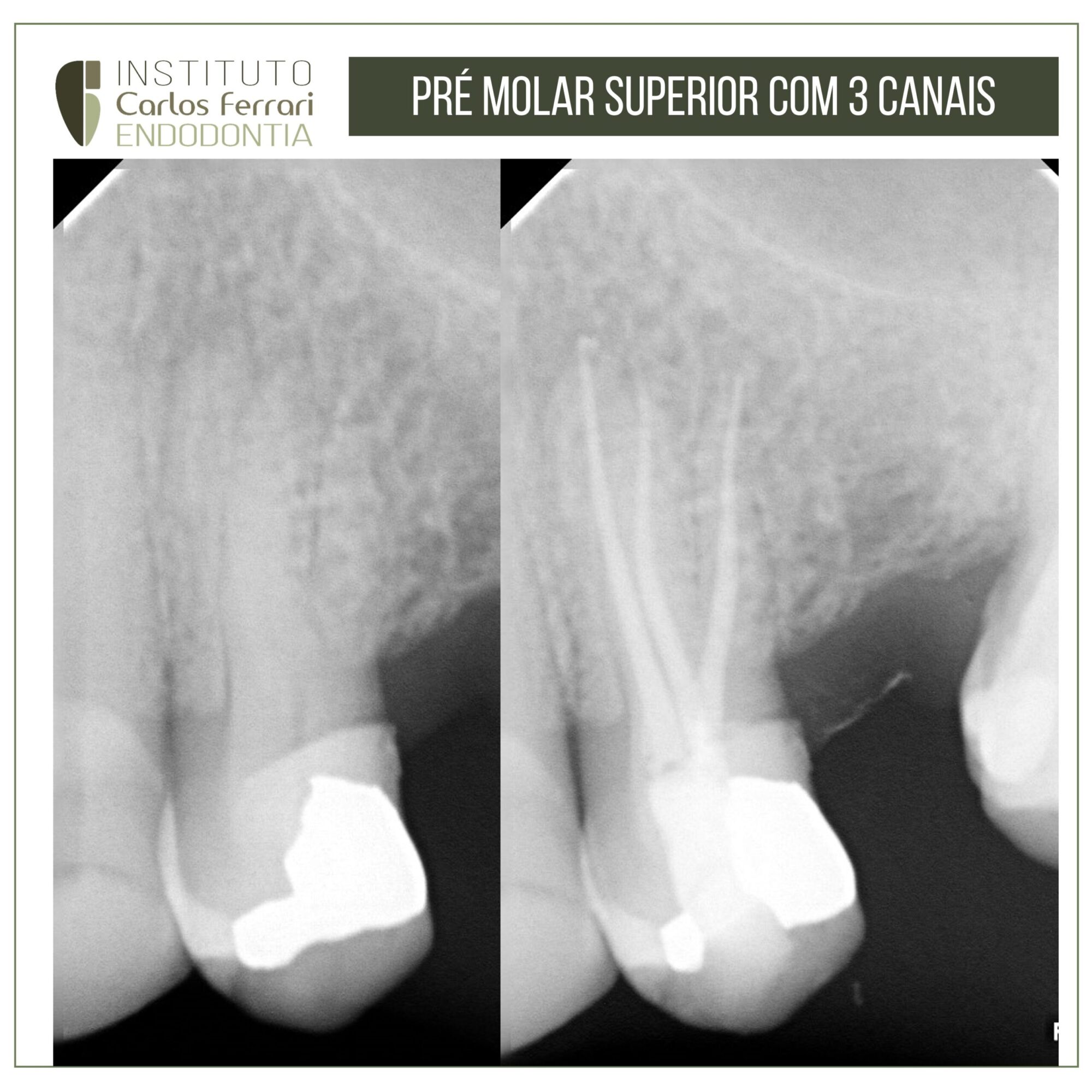 Pré-molar superior com três raízes e três canais.