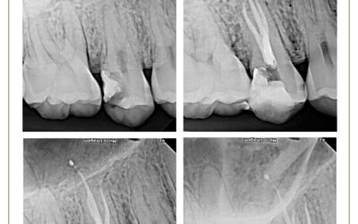 Pré-molar superior com 3 canais. Tratamento endodôntico.