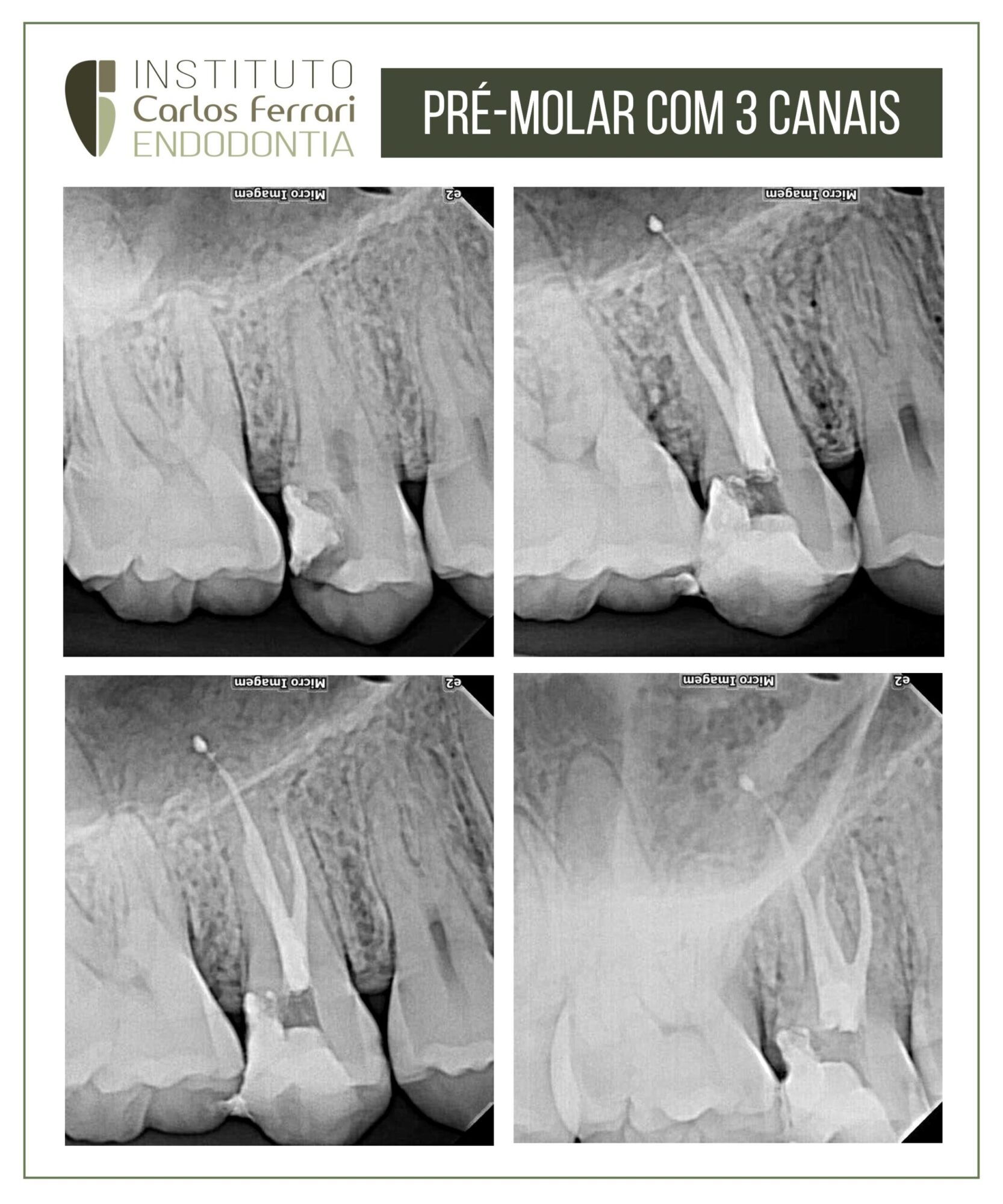 Pré-molar superior com 3 canais. Tratamento endodôntico.