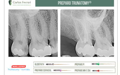Preparo endodôntico com o sistema Trunatomy