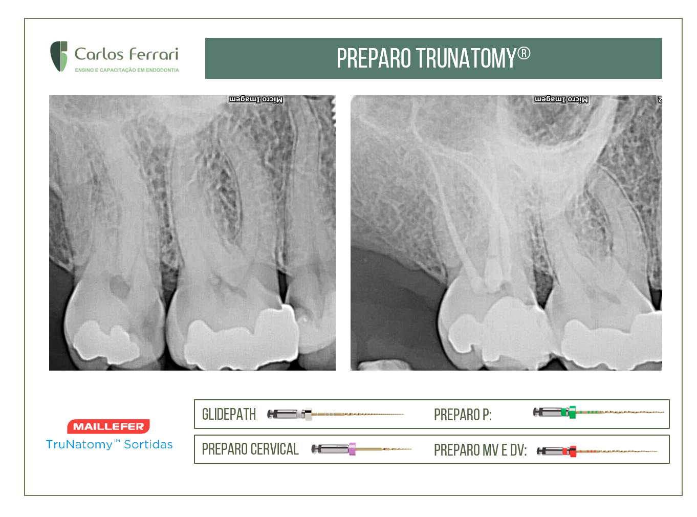 Preparo endodôntico com o sistema Trunatomy