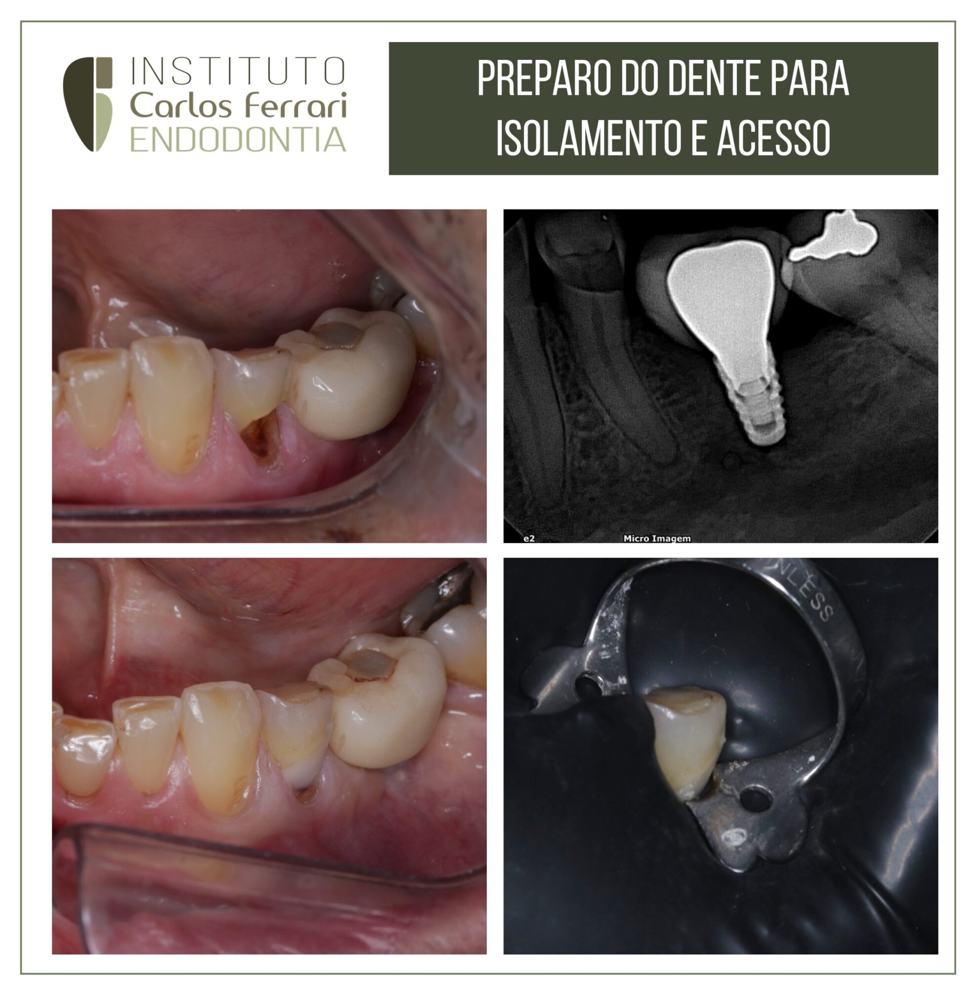 Preparo do dente para isolamento e cirurgia de acesso.