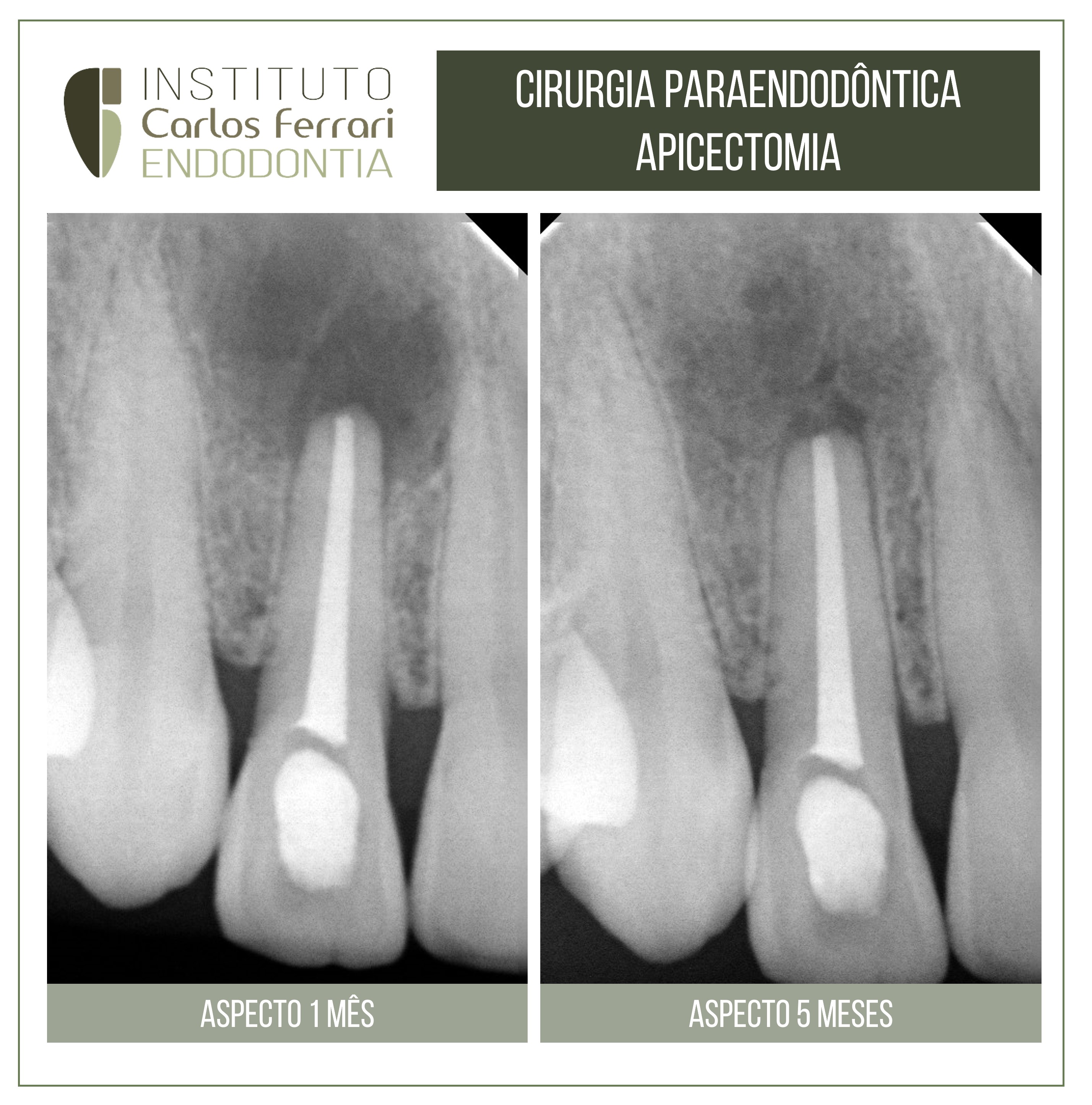Apicectomia em cirurgia paraendodôntica.