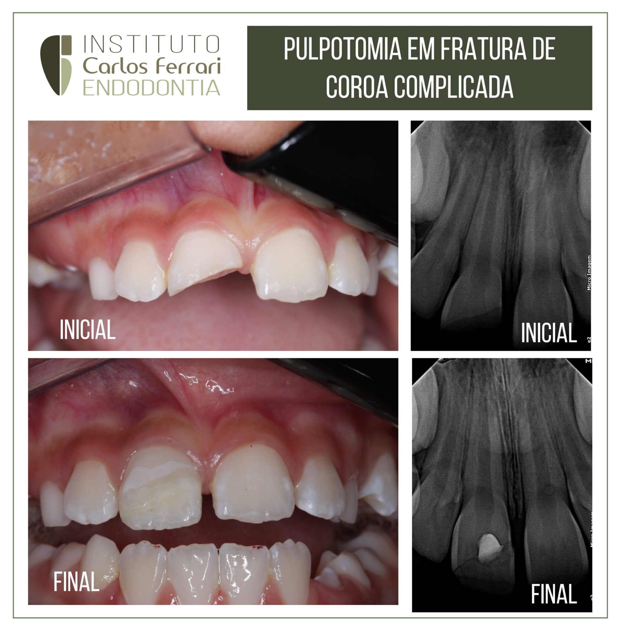 Pulpotomia e fratura de coroa complicada. Relato de caso.