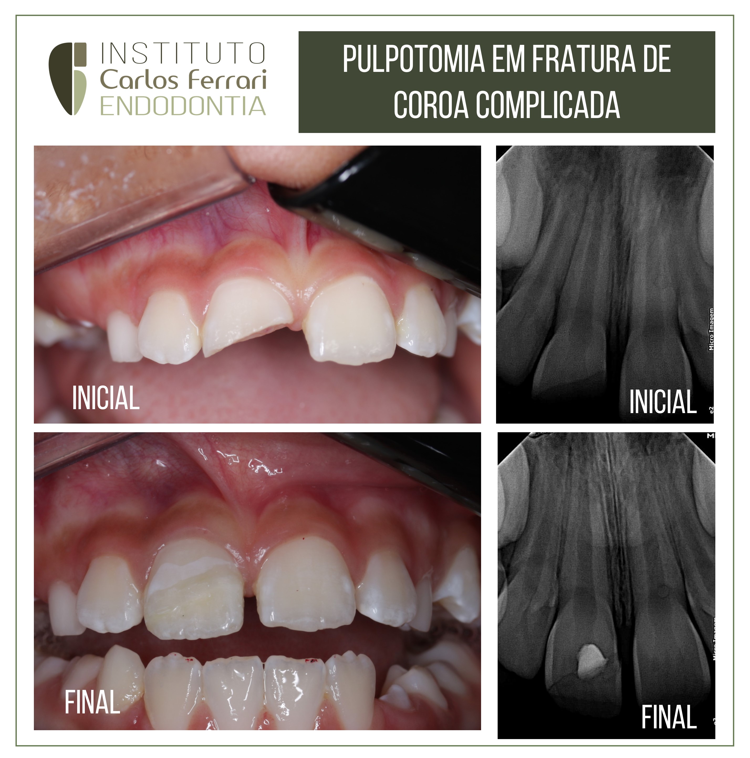 Pulpotomia e fratura de coroa complicada. Relato de caso.