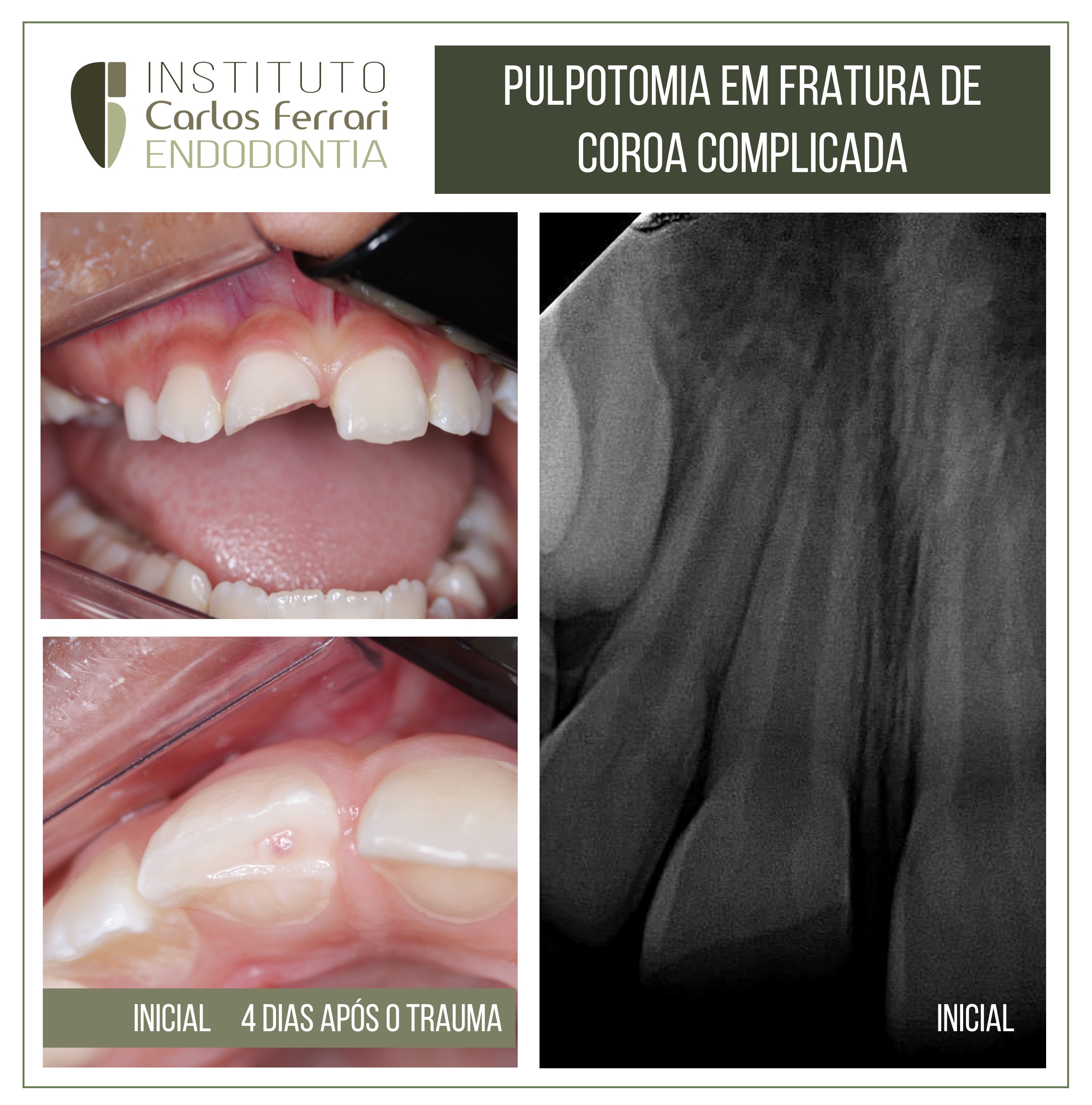 Pulpotomia e fratura de coroa complicada. Relato de caso.