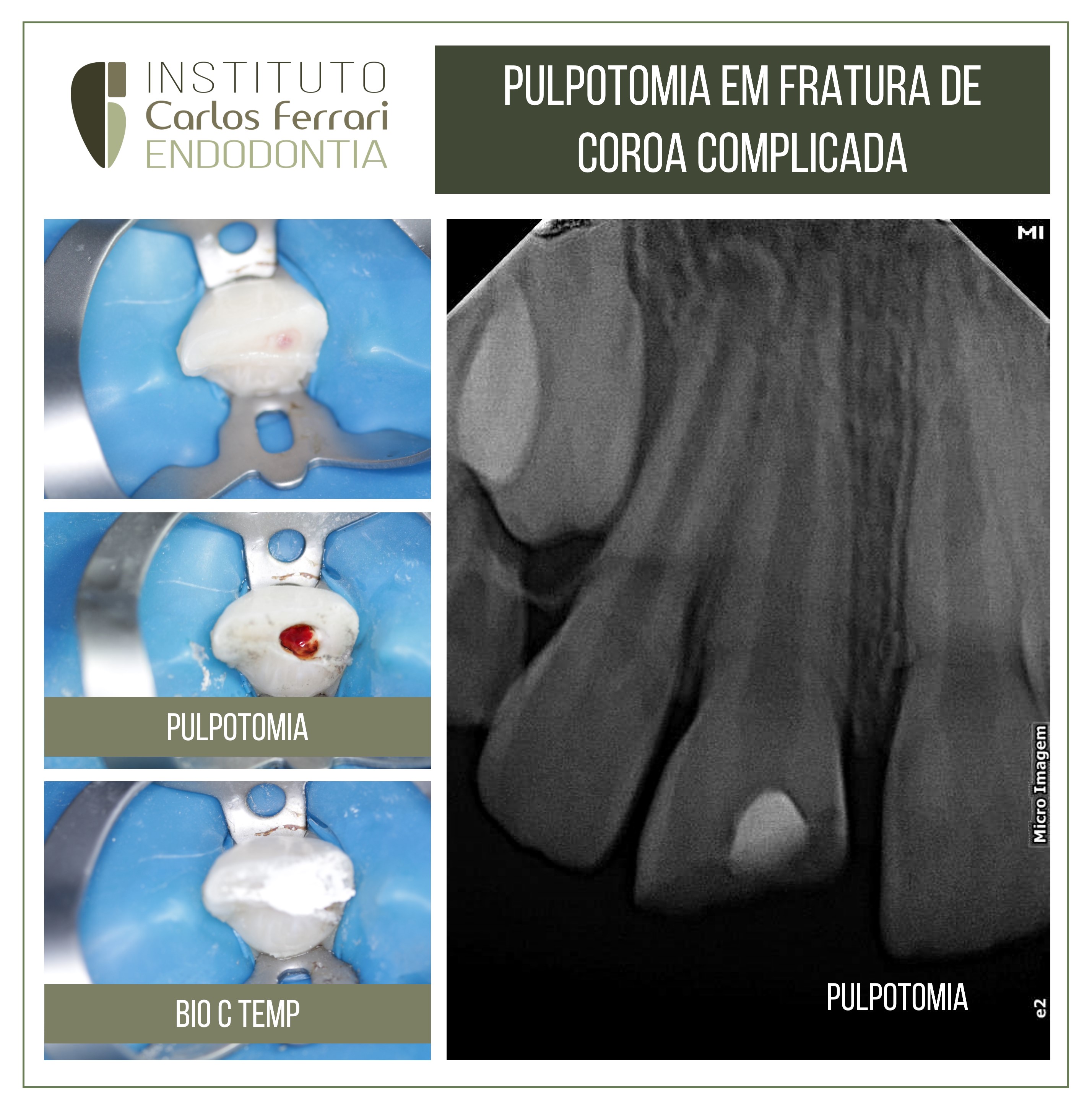 Pulpotomia e fratura de coroa complicada. Relato de caso.