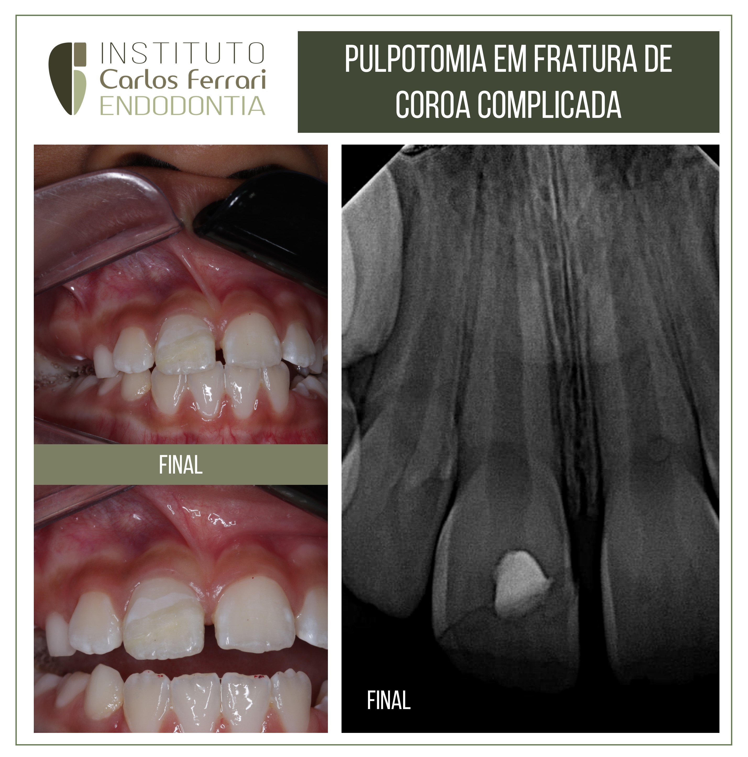 Pulpotomia e fratura de coroa complicada. Relato de caso.