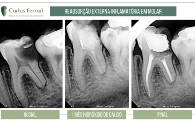 Reabsorção radicular externa em molar inferior.