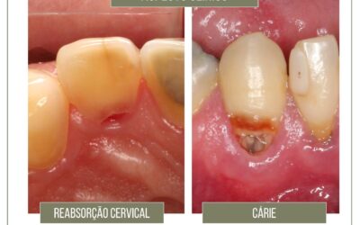 Reabsorção cervical ou cárie?
