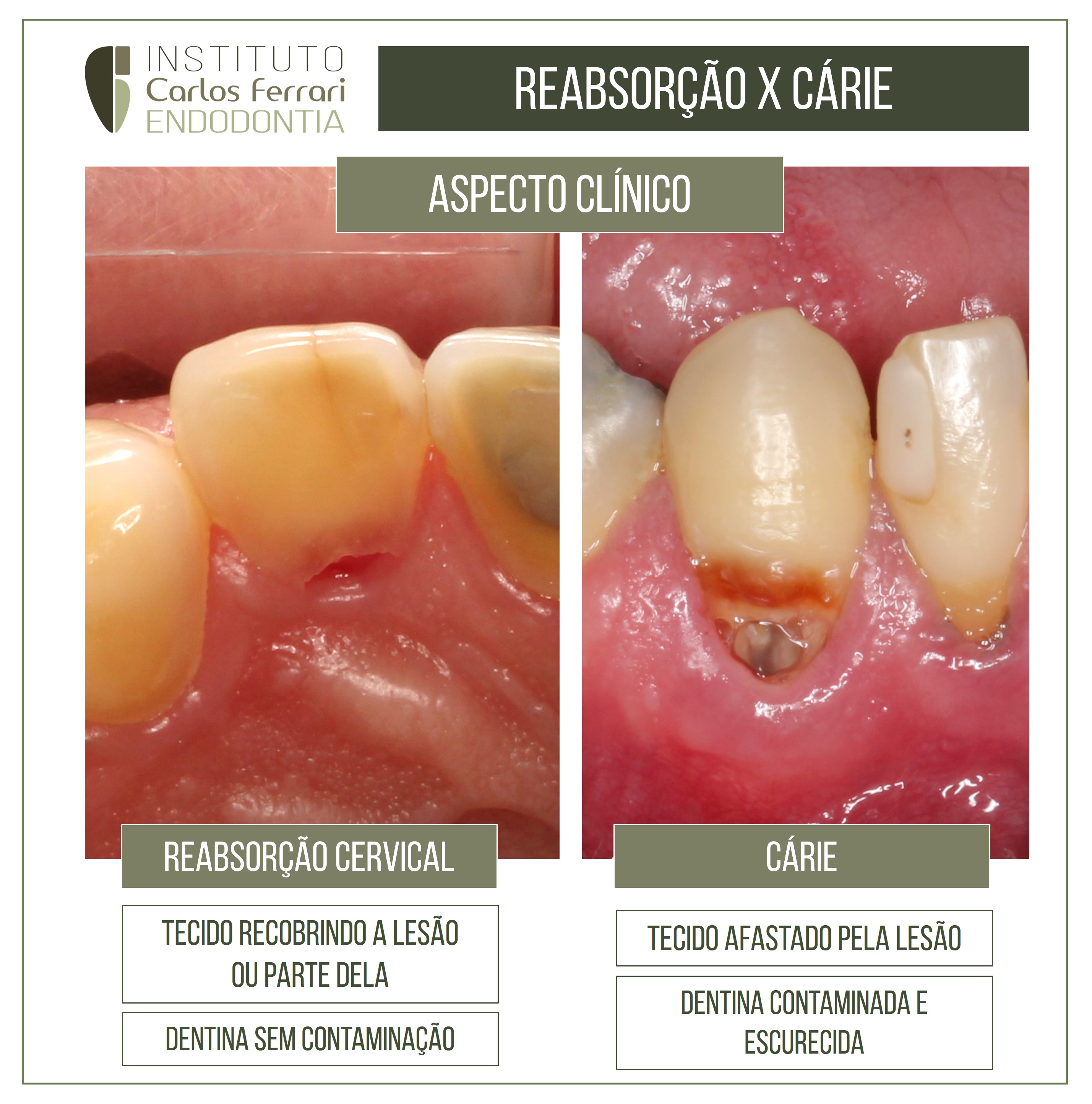 Reabsorção cervical ou cárie?