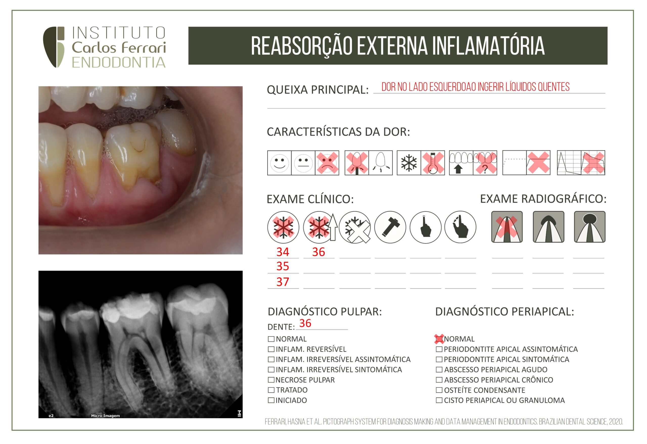 Reabsorção radicular externa inflamatória.