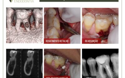 Reabsorção radicular externa inflamatória.