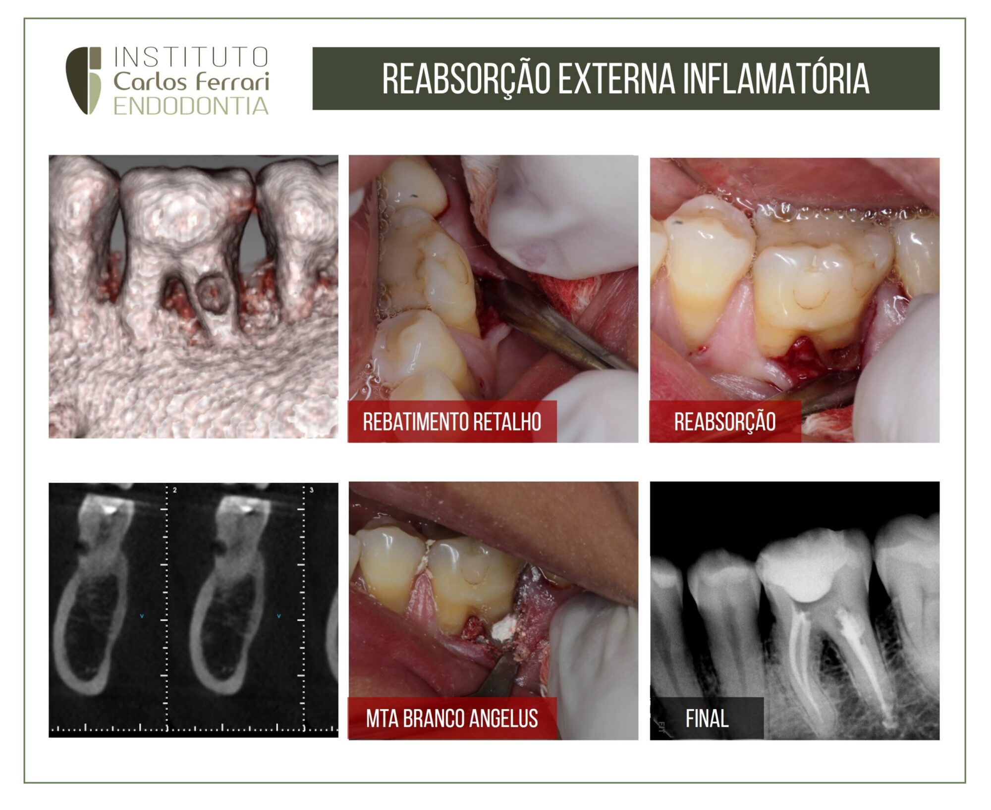 Reabsorção radicular externa inflamatória.