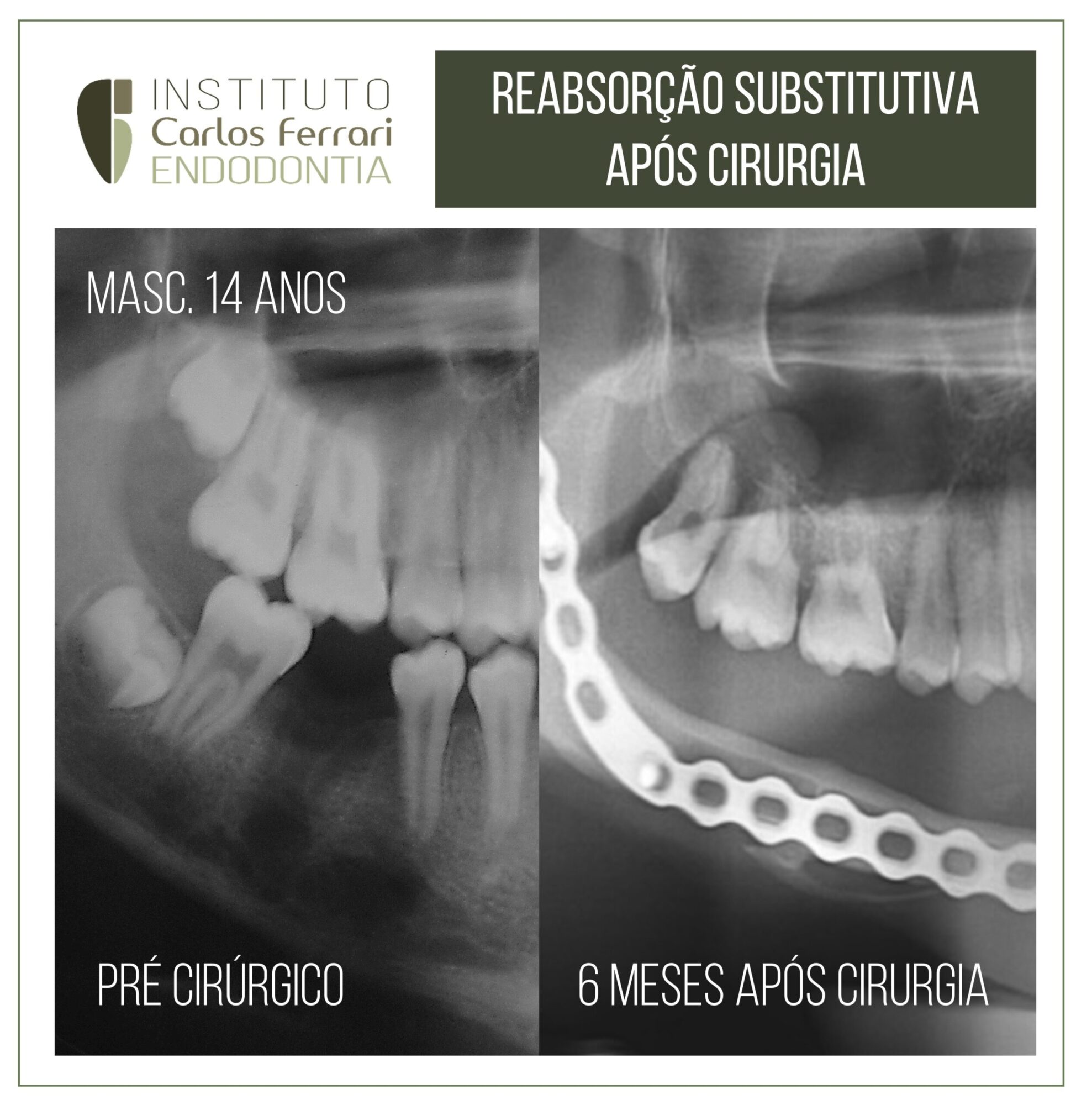 Reabsorção substitutiva após cirurgia.