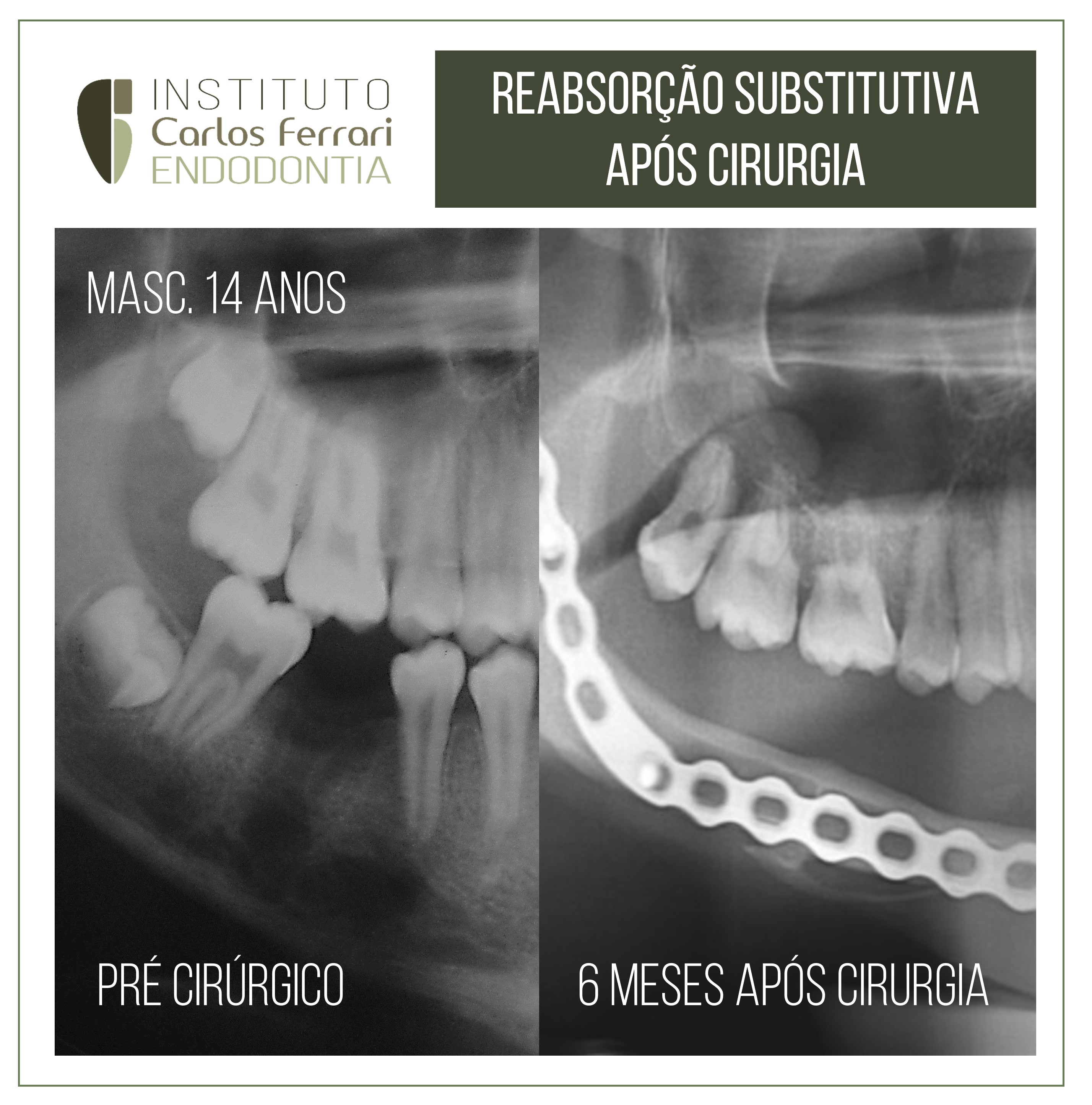 Reabsorção substitutiva após cirurgia.
