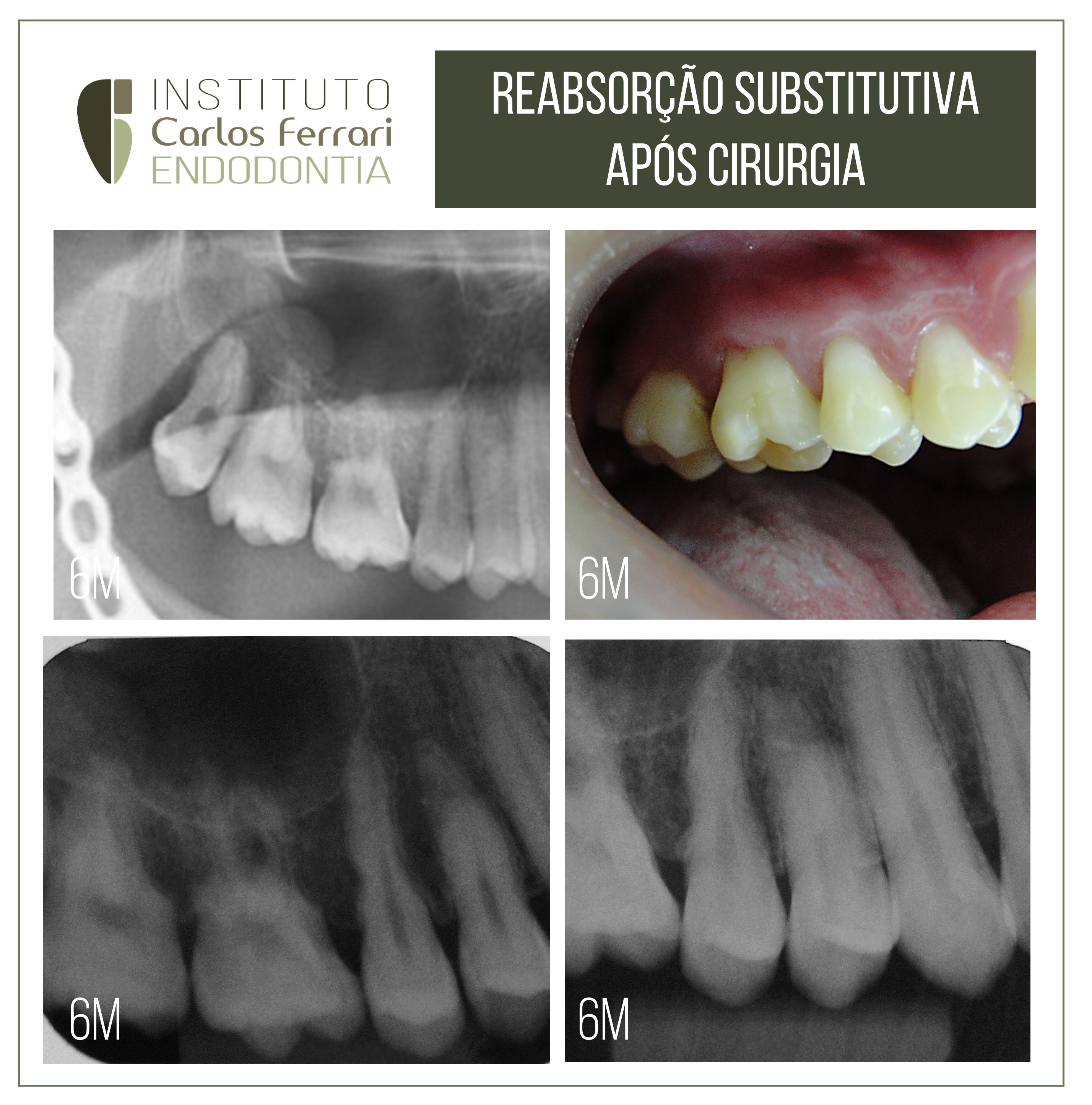 Reabsorção substitutiva após cirurgia.