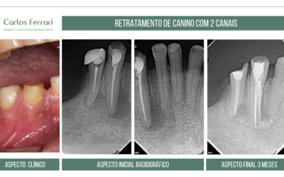 Anatomia endodôntica. Retratamento de canino com dois canais.
