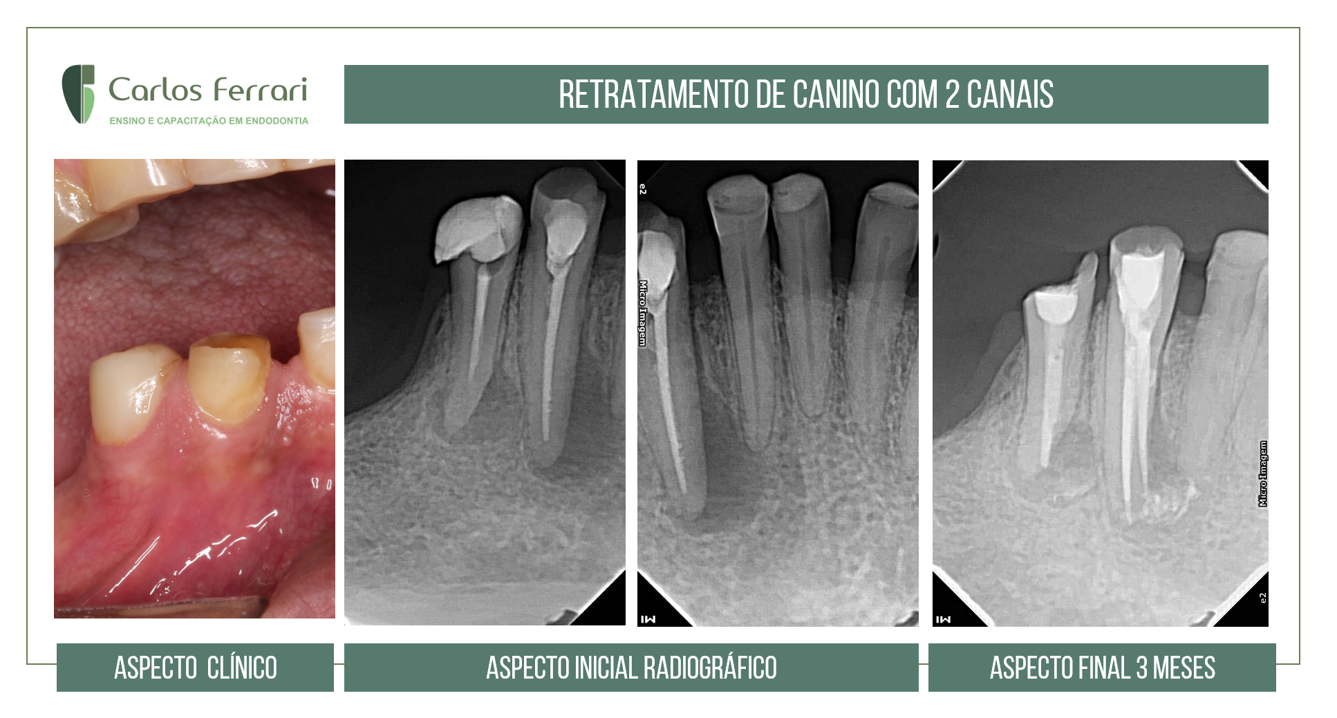 Anatomia endodôntica. Retratamento de canino com dois canais.