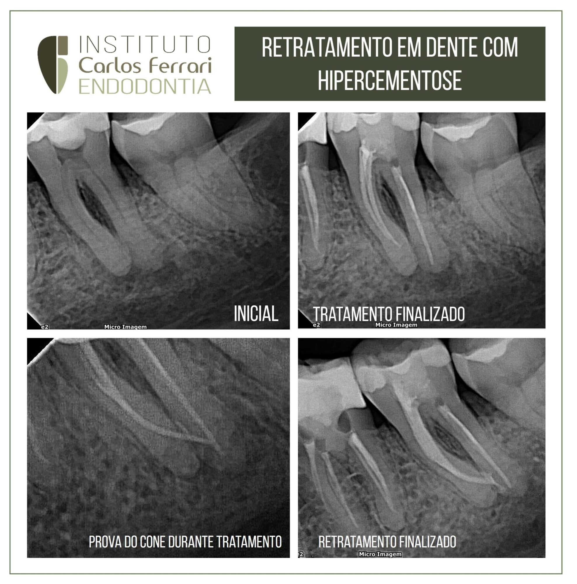 Retratamento em dente com hipercementose.