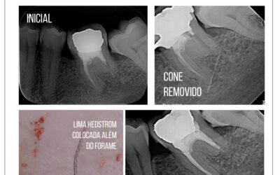 Retratamento em dente com reabsorção externa.