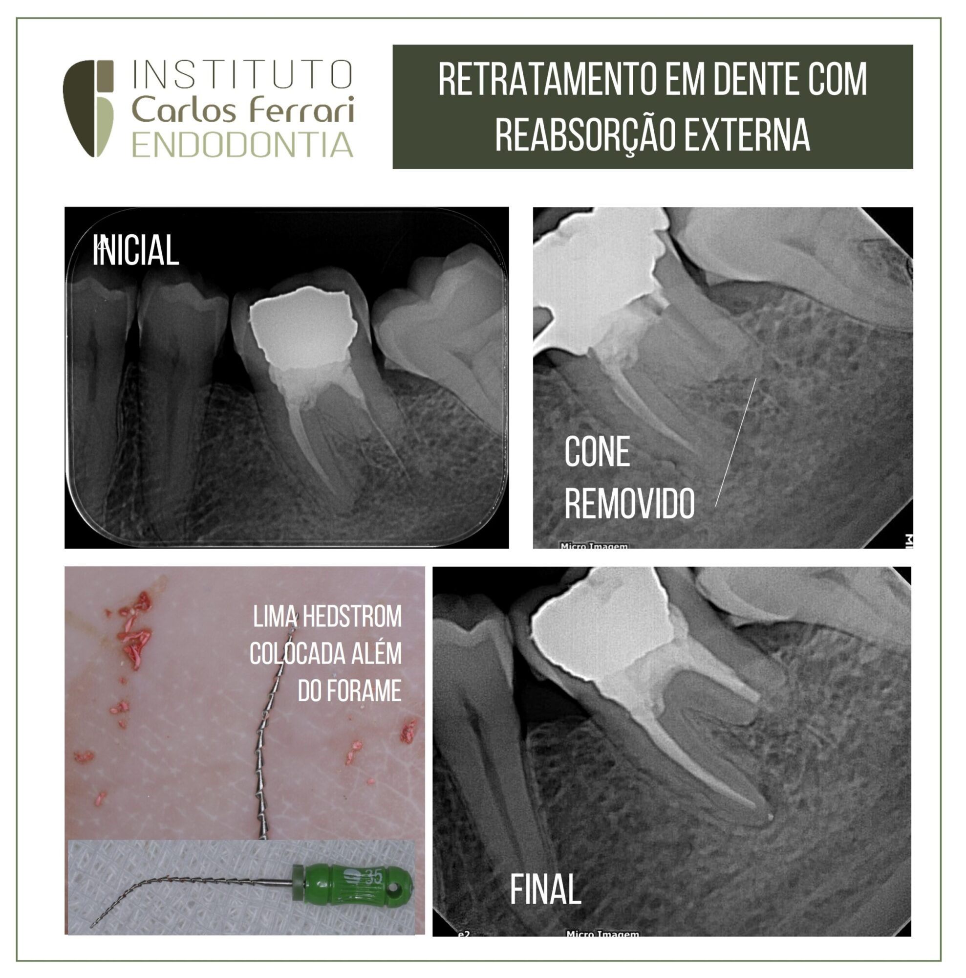 Retratamento em dente com reabsorção externa.