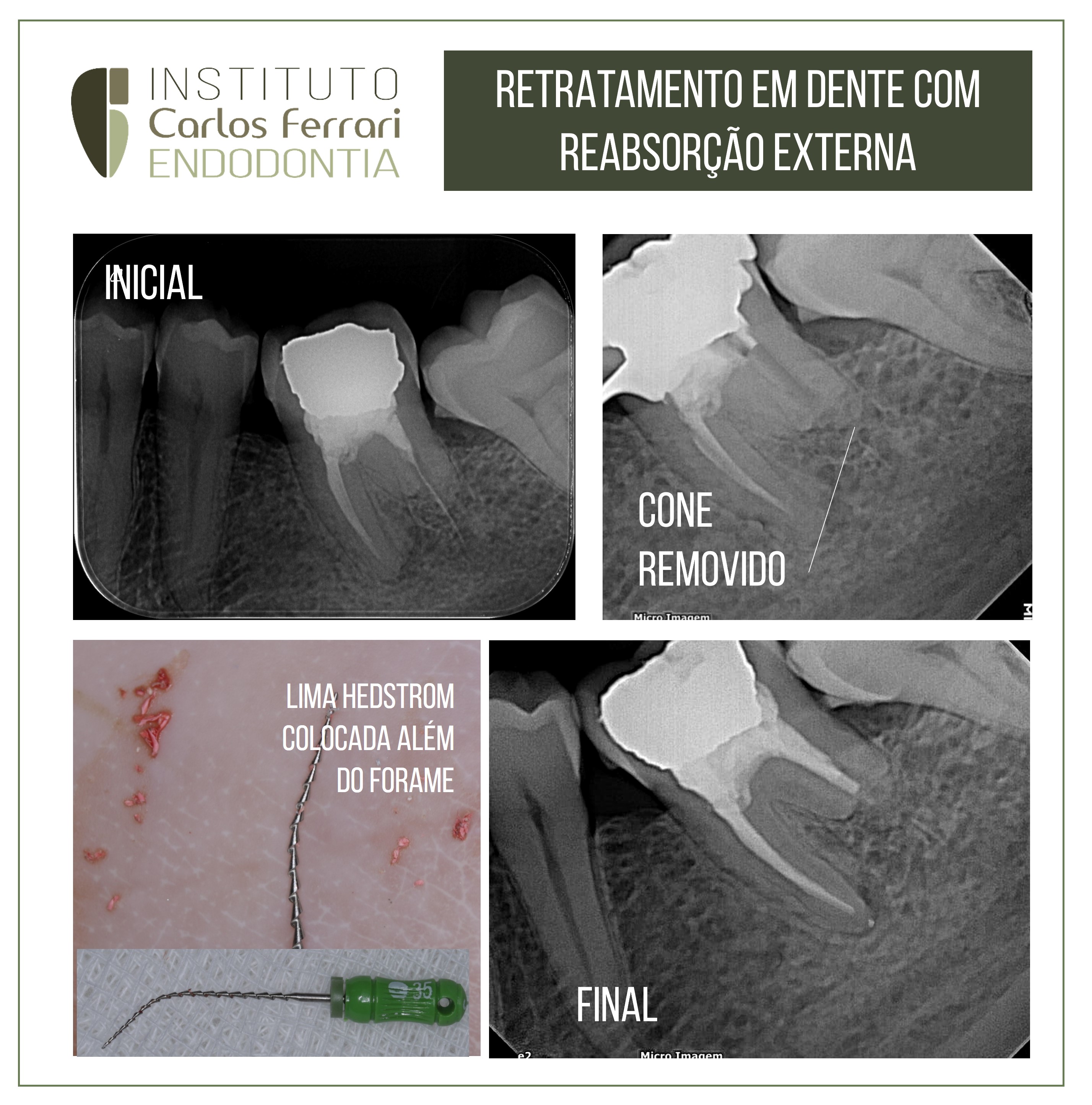 Retratamento em dente com reabsorção externa.