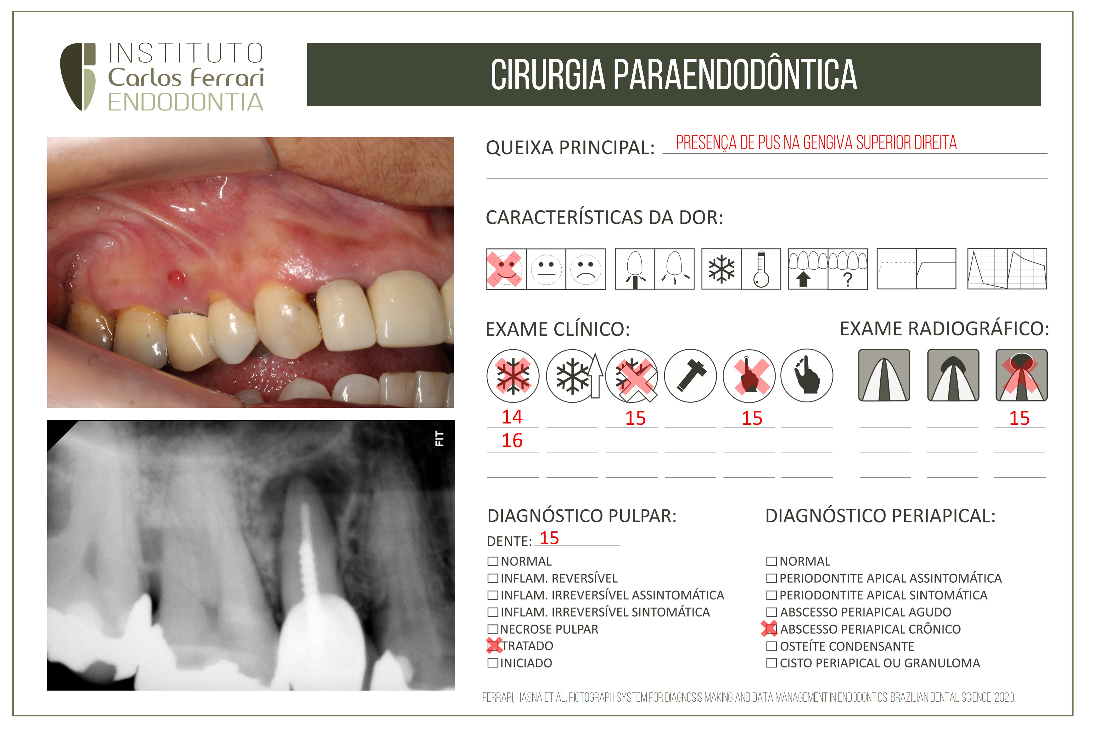 Retro obturação com MTA. Cirurgia paraendodôntica.