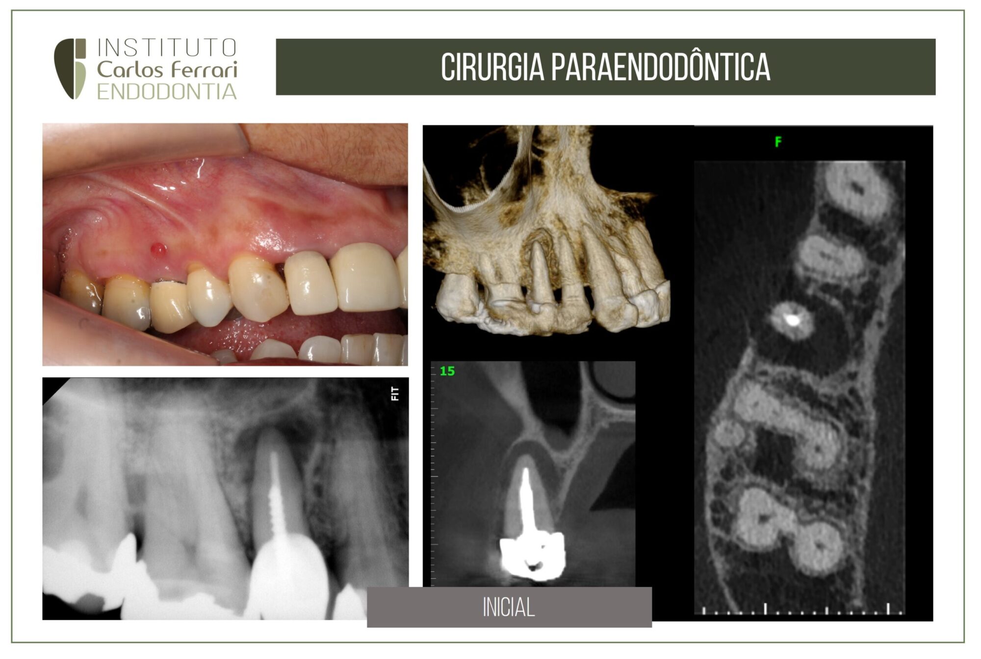 Retro obturação com MTA. Cirurgia paraendodôntica.