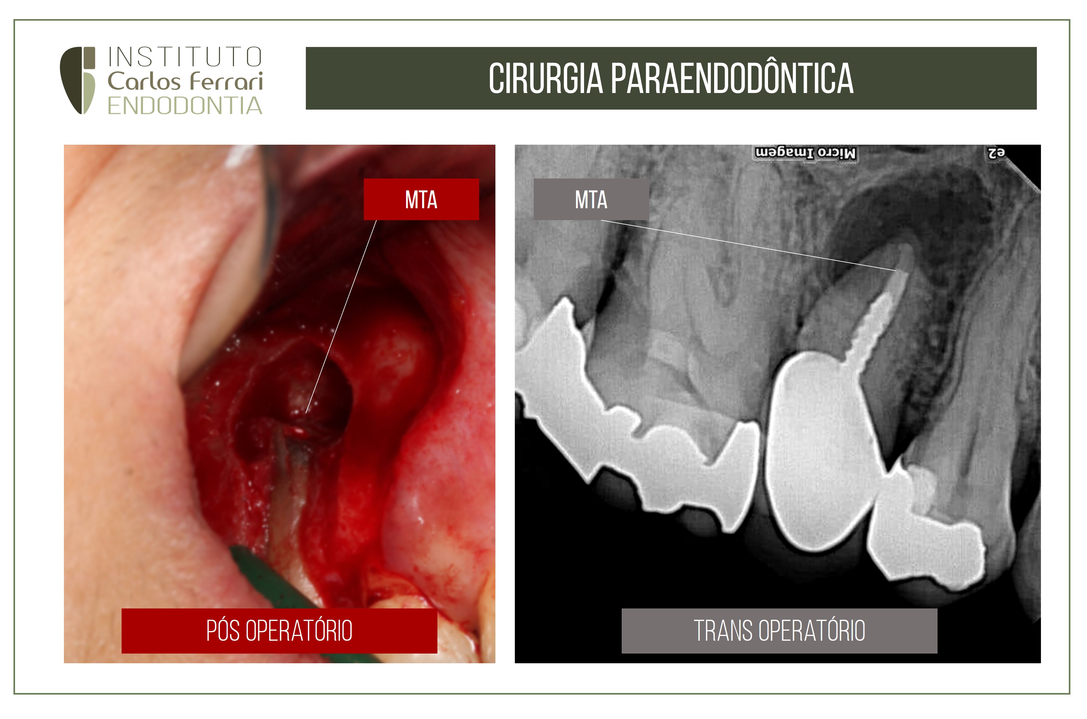 Retro obturação com MTA. Cirurgia paraendodôntica.