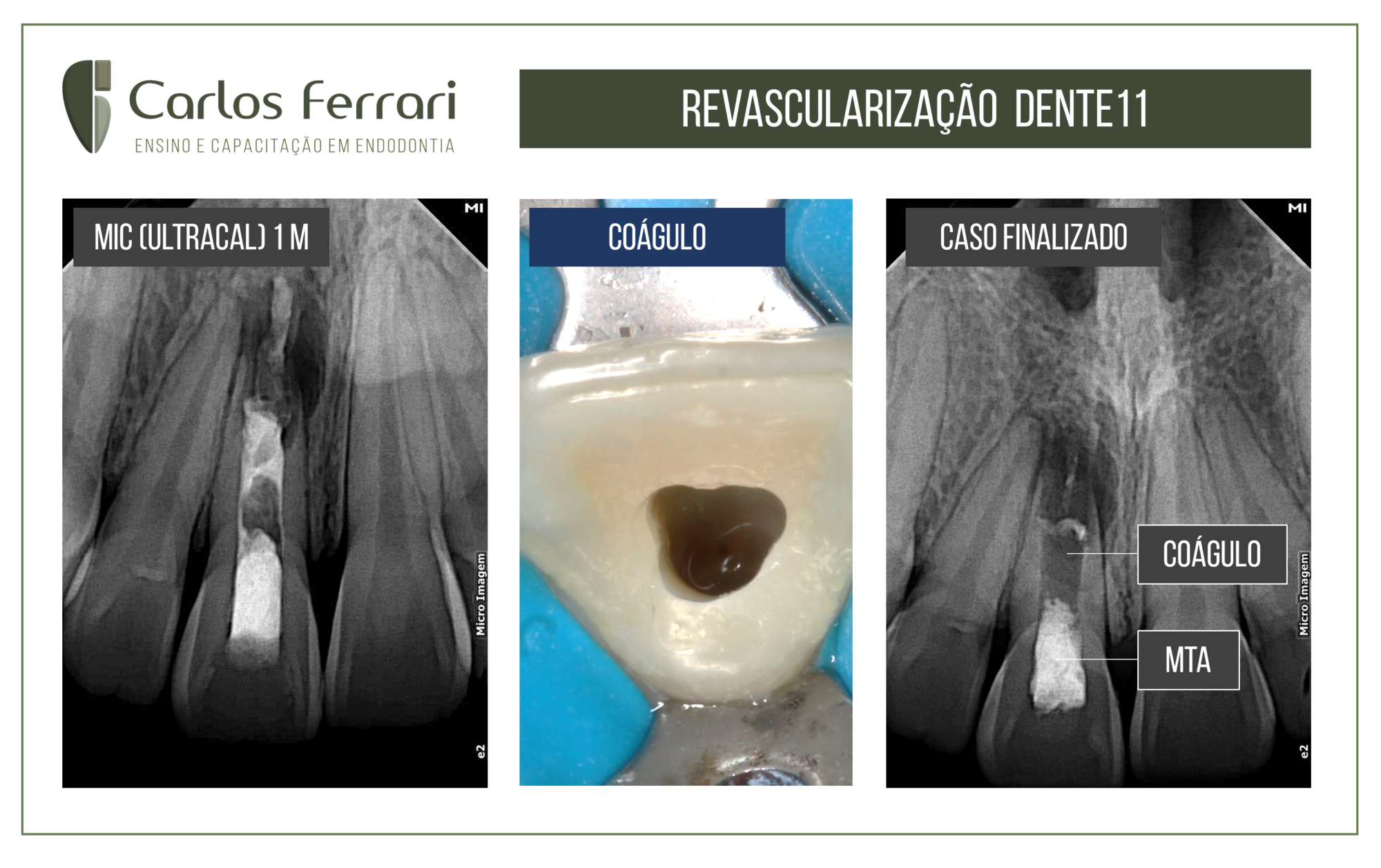 Revascularização pulpar. Caso em paciente adulto.