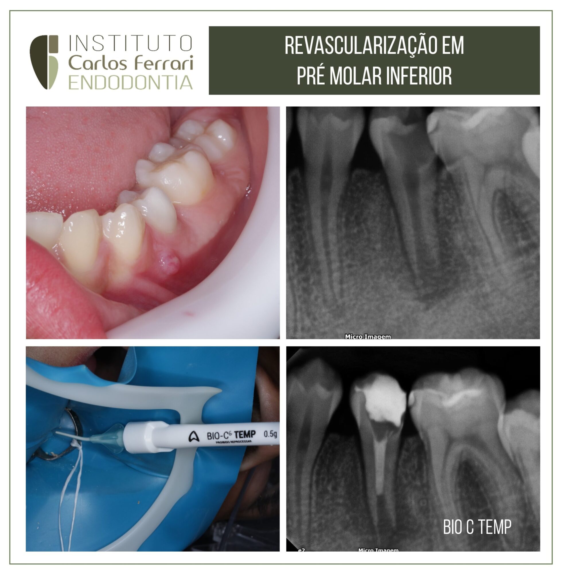 Revascularização em dente com rizogênese incompleta.