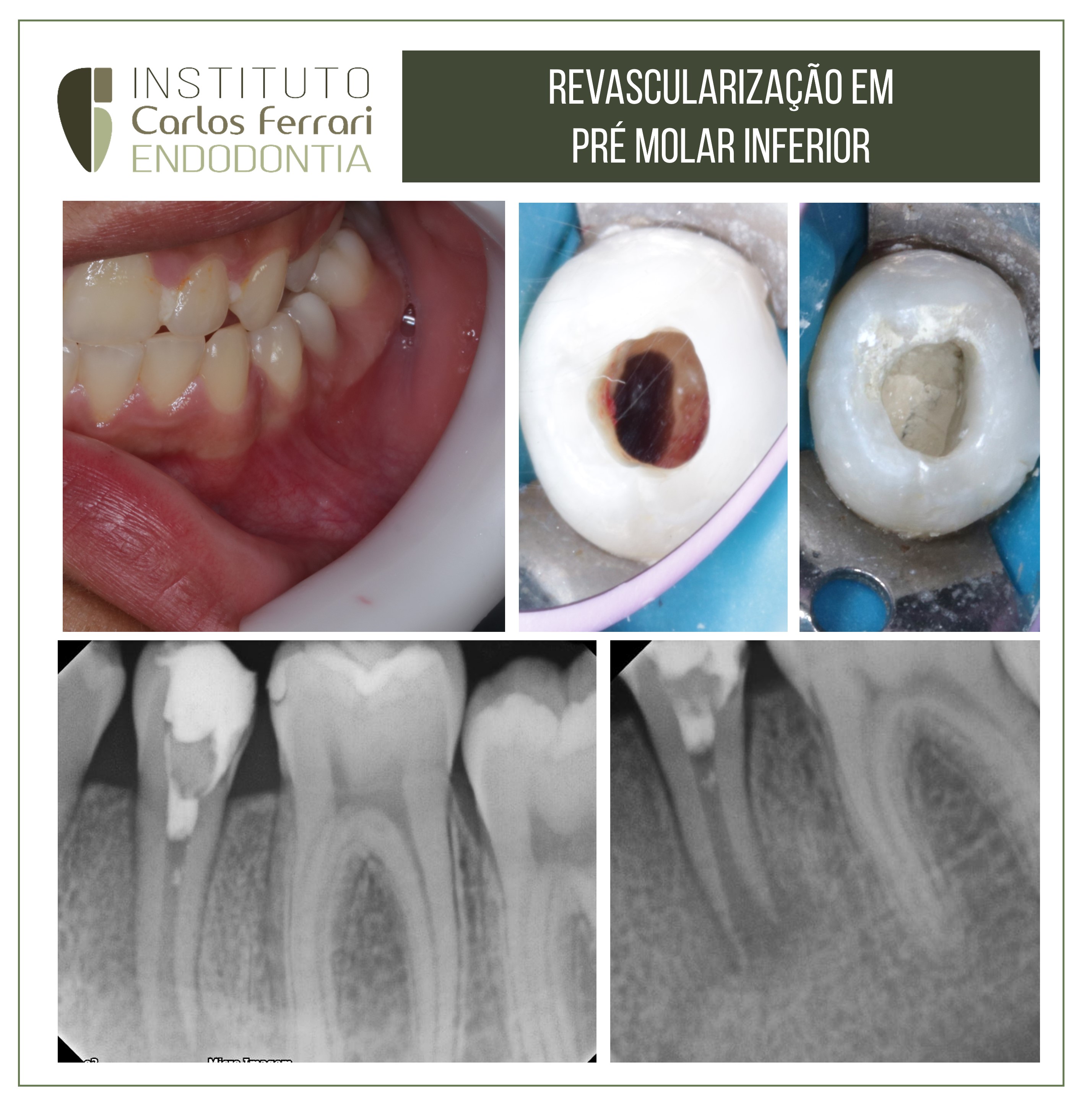 Revascularização em dente com rizogênese incompleta.