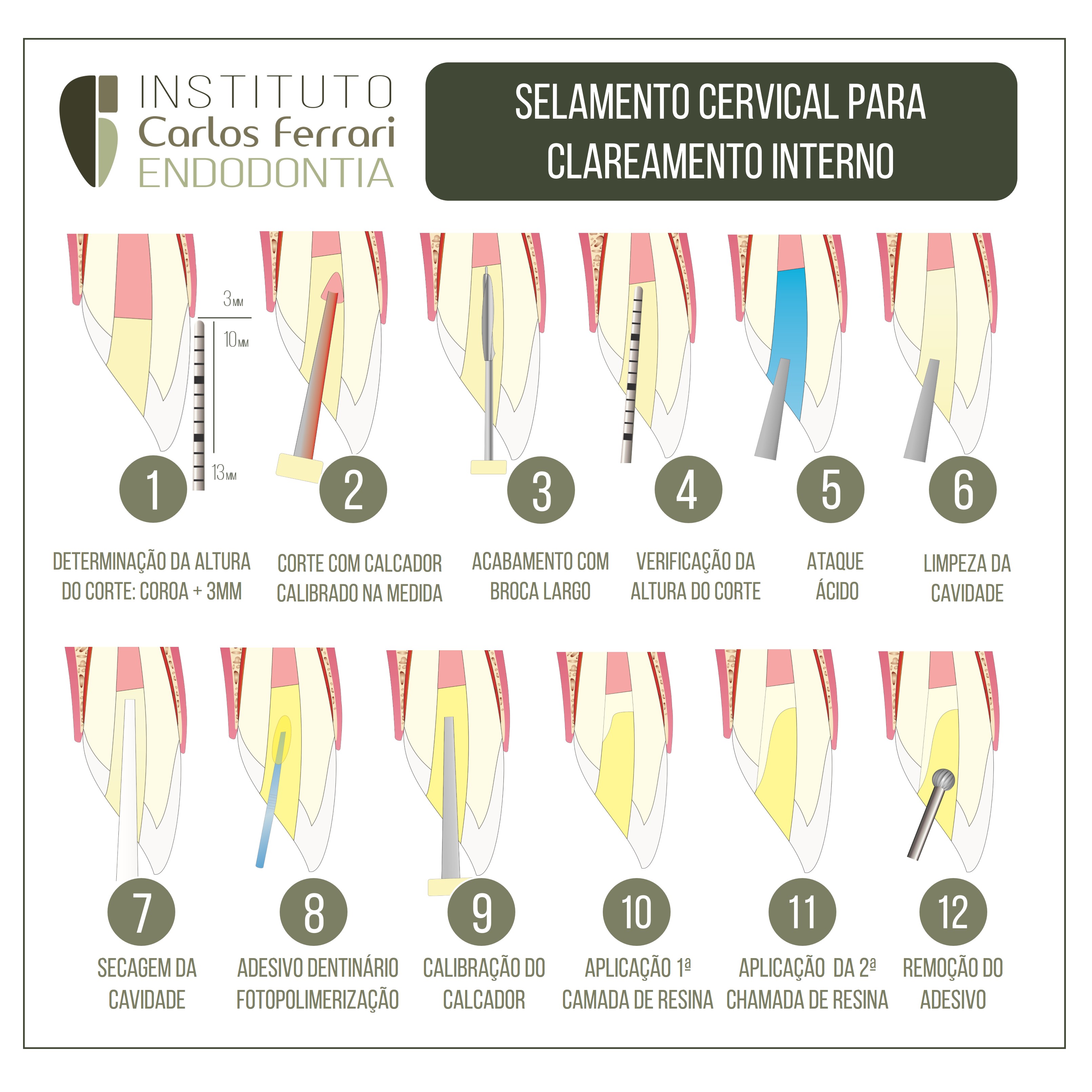 Selamento cervical para clareamento interno.
