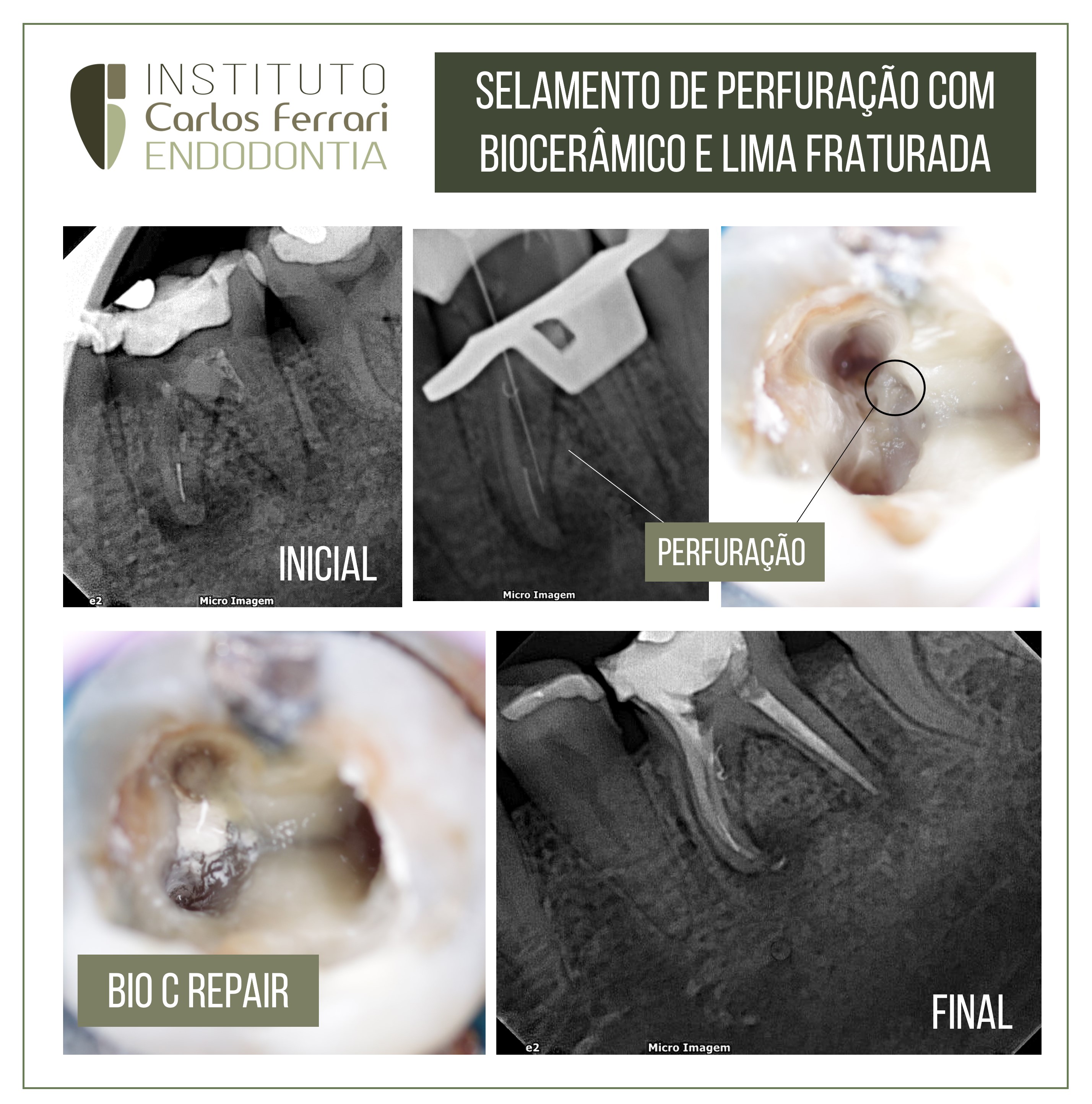 Selamento de perfuração com biocerâmico e lima fraturada.