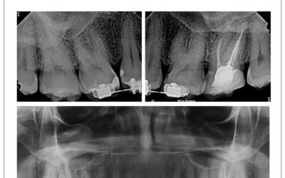 Sinusite odontogênica bilateral