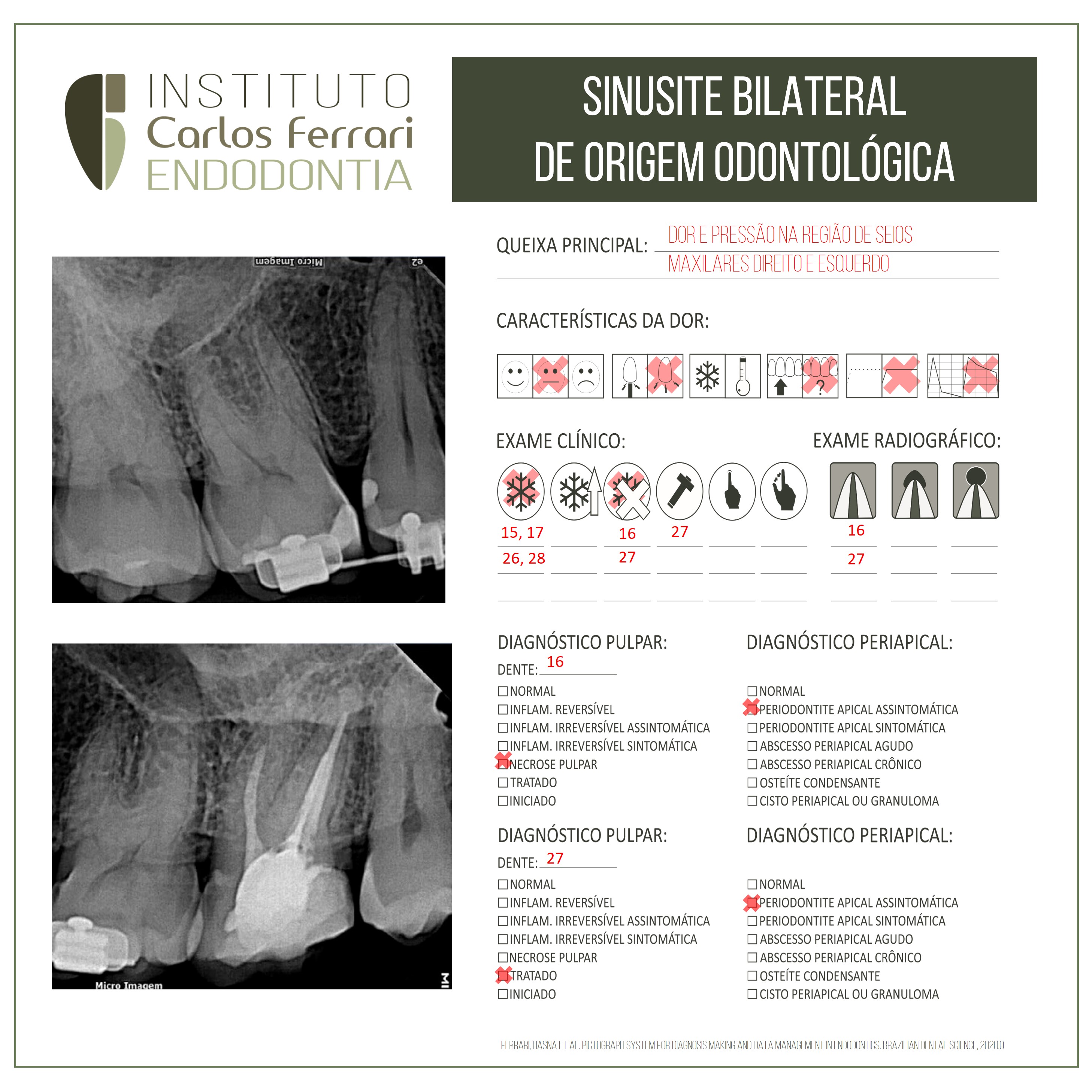 Sinusite odontogênica bilateral