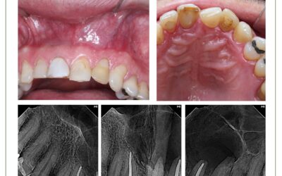 Tratamento endodôntico de um cisto periapical.