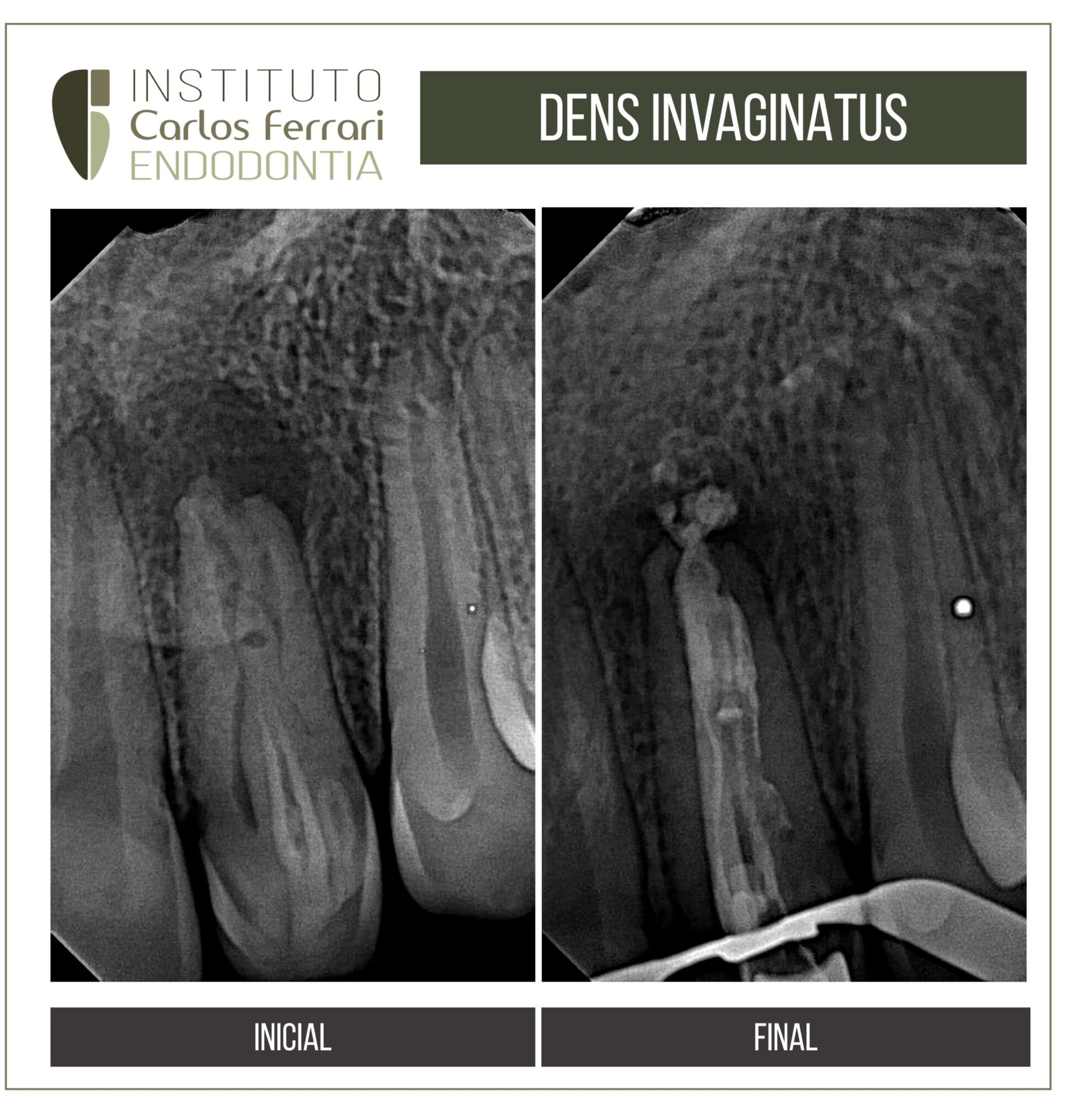 Tratamento endodôntico de dens invaginatus.