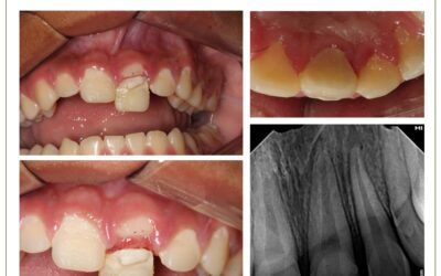 Traumatismo dental. Fratura coroa raiz não complicada.