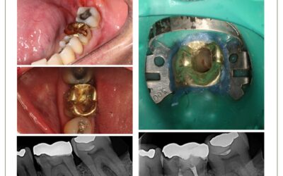 Urgência endodôntica em molar com coroa metálica.