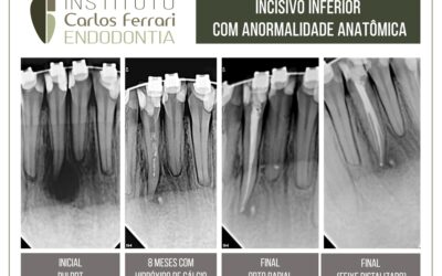 Anatomia dental. Anormalidade no incisivo inferior.