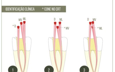 Anatomia na endodontia. Molar com 3 canais e um forame.